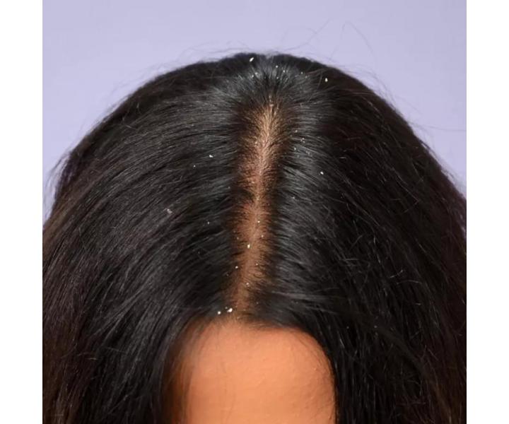 Upokojuj�ce s�rum na poko�ku hlavy proti lupin�m Schwarzkopf Professional BC Bonacure Anti-Dandruff Serum - 100 ml